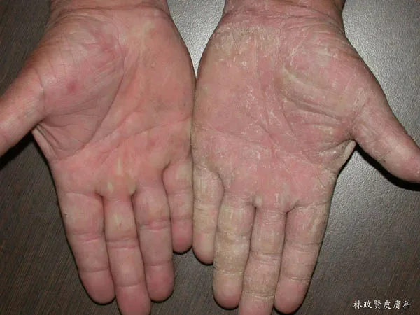 Seasonal Shedding or Disease? Exfoliative Keratolysis - My, The medicine, Disease, Disease history, Body check, Longpost, Doctors, Problem skin, Leather, Dermatology, Kvd, Treatment, Genetic diseases