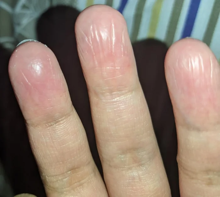 Seasonal Shedding or Disease? Exfoliative Keratolysis - My, The medicine, Disease, Disease history, Body check, Longpost, Doctors, Problem skin, Leather, Dermatology, Kvd, Treatment, Genetic diseases