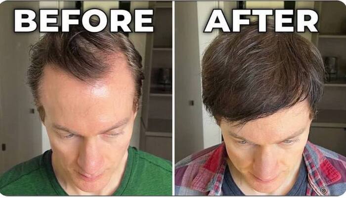 ПОБЕЖДАЕМ ОБЛЫСЕНИЕ