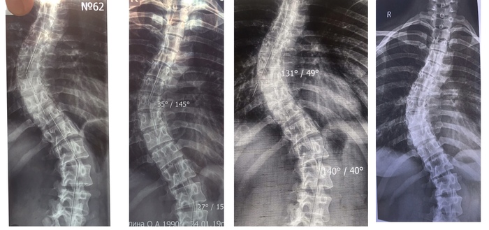 слева направо: 2018, 2019, 2020, 2021. Потом я перестала делать снимки так часто. Последний я не забрала, есть только описание. В 2021 в грудном 40 гр и 12 в поясничном. В 2024 в грудном 39 гр., а поясницу я не сделала