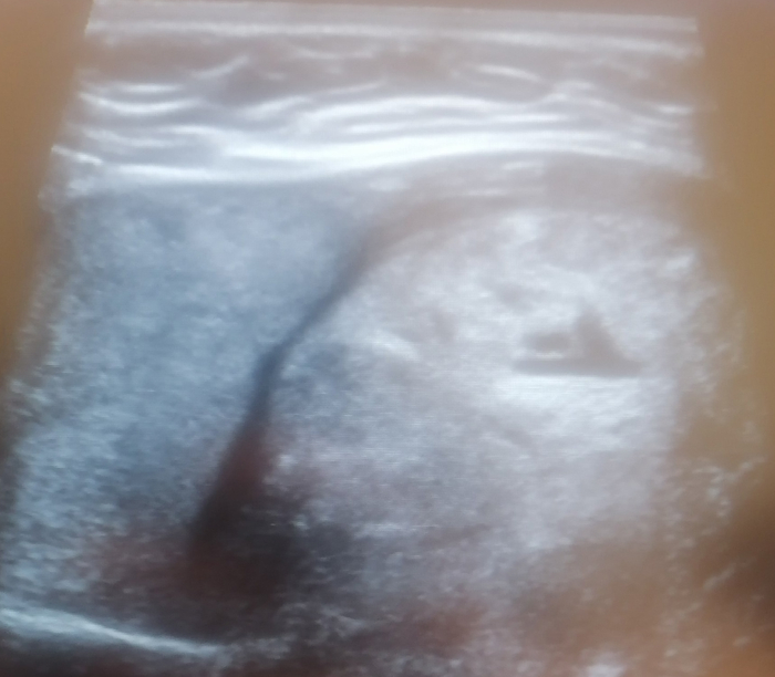 ��������� � TIRADS 3