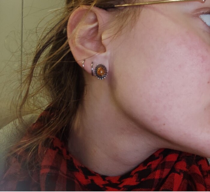 Акне ДО и ПОСЛЕ.