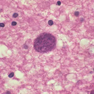 Toxoplasmosis - Series Protozoa, My, Treatment, Doctors, The medicine, Parasites, Toxoplasmosis, Pregnancy