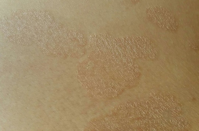 Отрубевидное шелушение