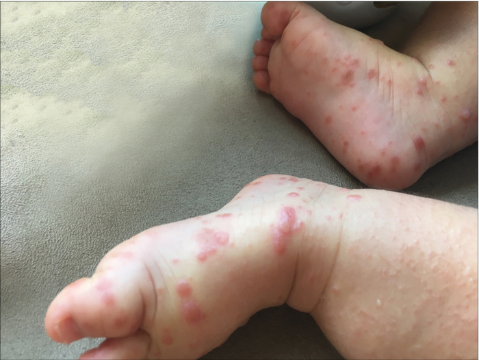 Пятнисто-папуллезная сыпь. Получено информированное согласие законных представителей на публикацию изображения.