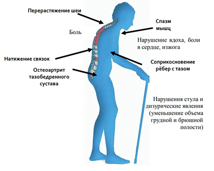 Остеоартрит - воспаление всех компонентов сустава