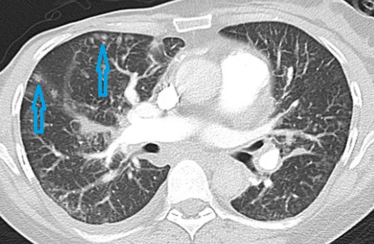 Немногочисленные перилимфатические очаги в правом легком на КТ