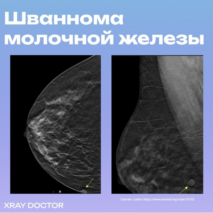 Интересный случай: шваннома молочной железы