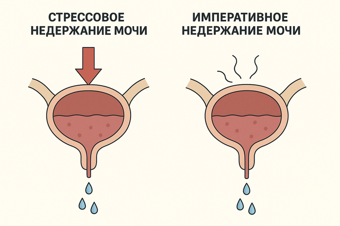 Стрессовое- слабость запирательного механизма в уретре, давление на мочевой пузырь извне. Императивное- гиперактивность мочевого пузыря, неудержимый позыв.