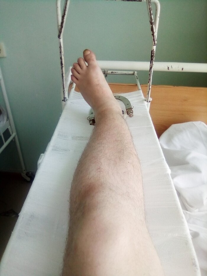 Ответ на пост «Какую травму вы получили по собственной глупости»