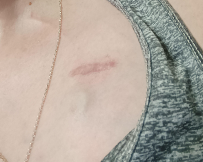 Шрам был тоньше, при заживлении стал шире, ниже него сам порт, в него колют катетер, на шее, около родинки видна трубочка, она первое время очень тянула артерию при повороте головы, спать больно, ощущение удушья было постоянно, сейчас полегче стало