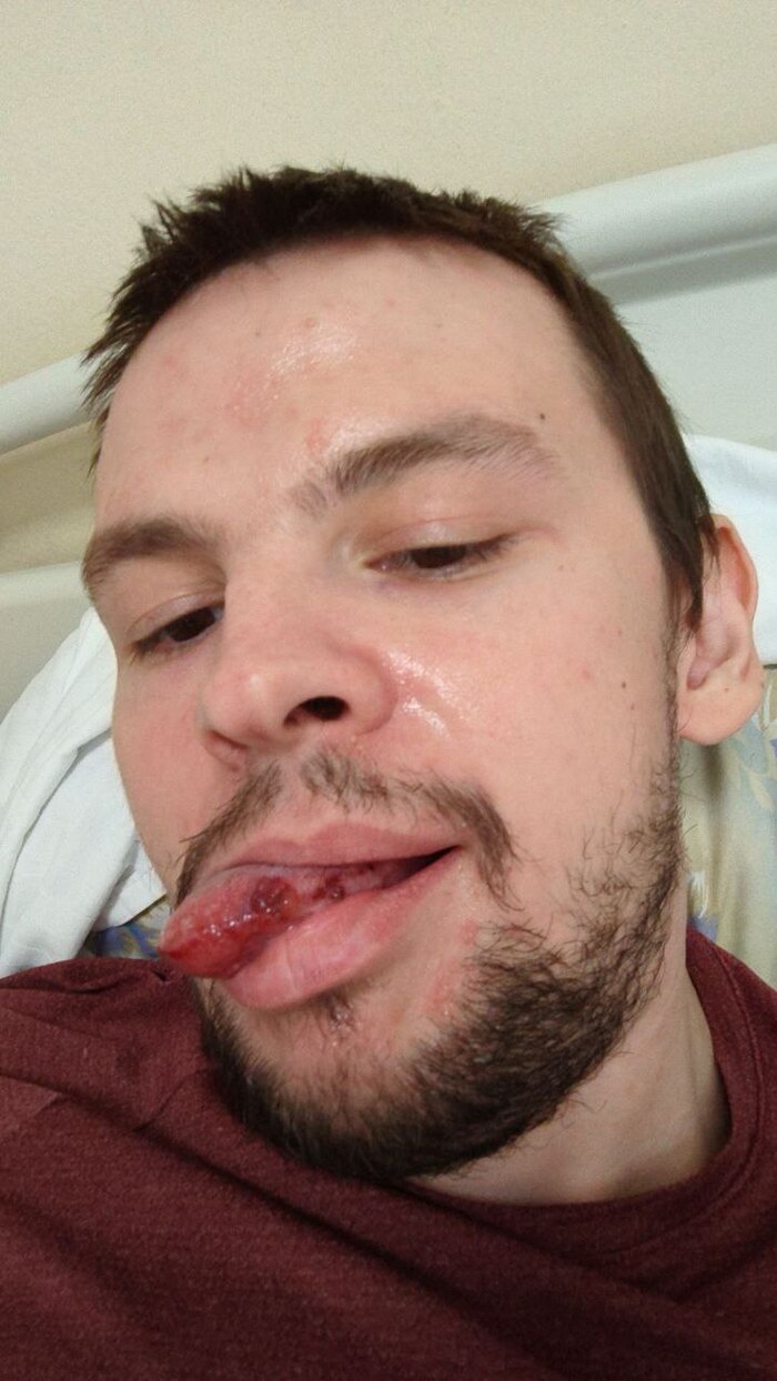 вот откуда была кроваваяпена,язык болел ещё полторы недели,очень долго заживал