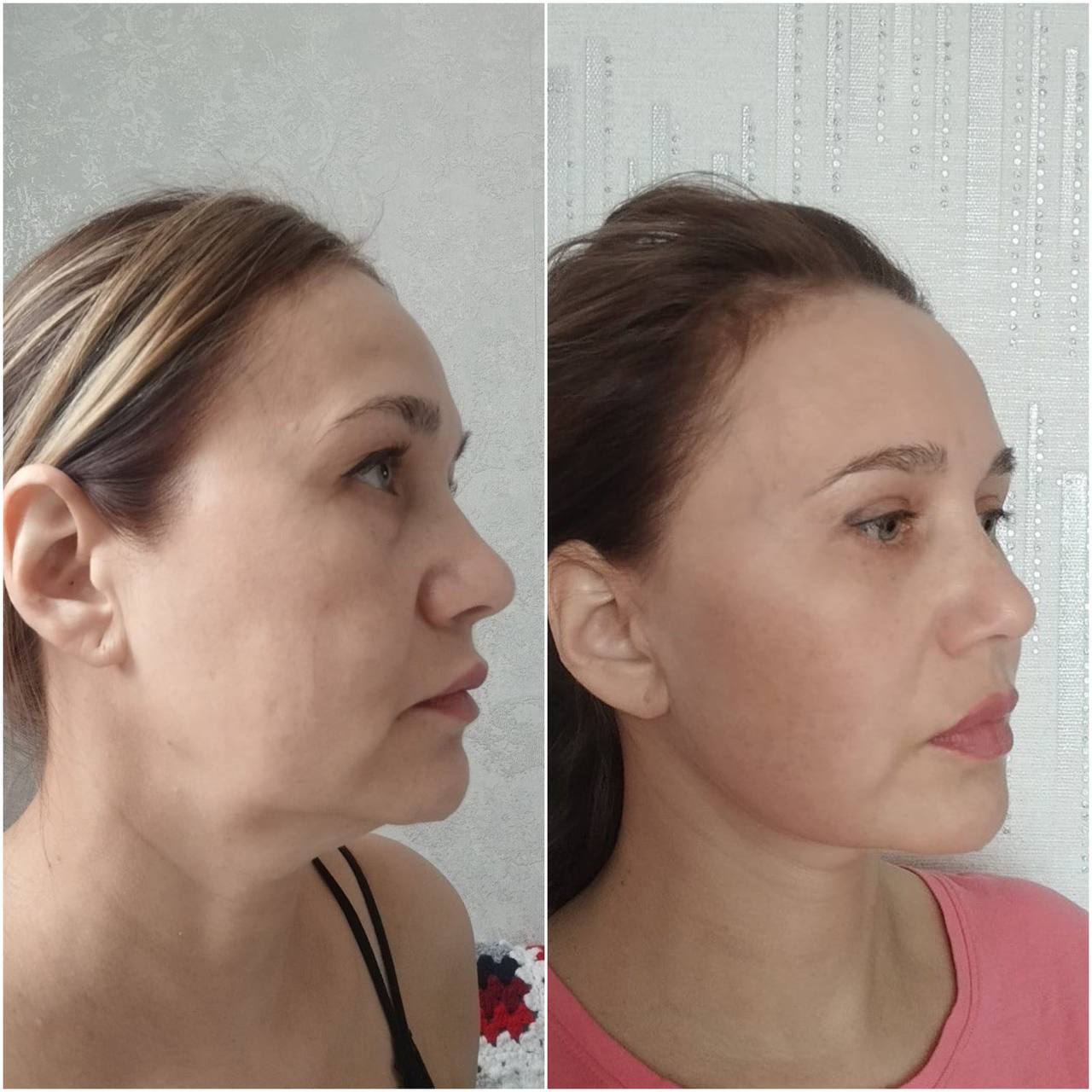 How to restore your original face without signs of overtightening? - My, Face, Facelift, Blepharoplasty, Video, Vertical video, Short videos, Longpost
