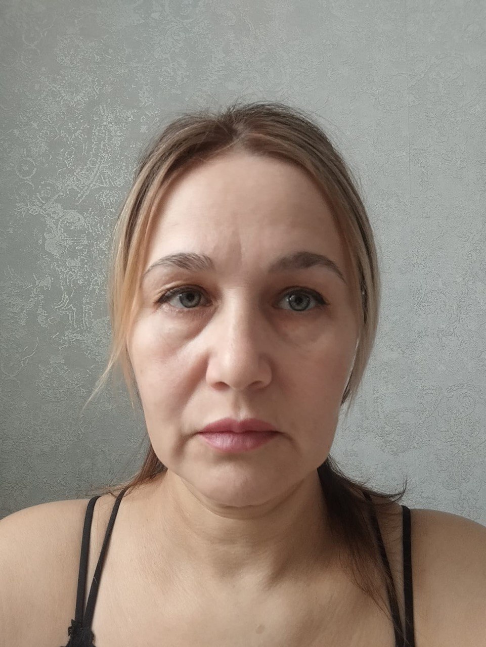 How to restore your original face without signs of overtightening? - My, Face, Facelift, Blepharoplasty, Video, Vertical video, Short videos, Longpost