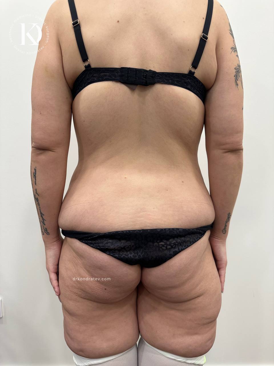 Body Correction After Massive Weight Loss, Part 2 - My, Redheads, Video, Vertical video, Longpost, Booty
