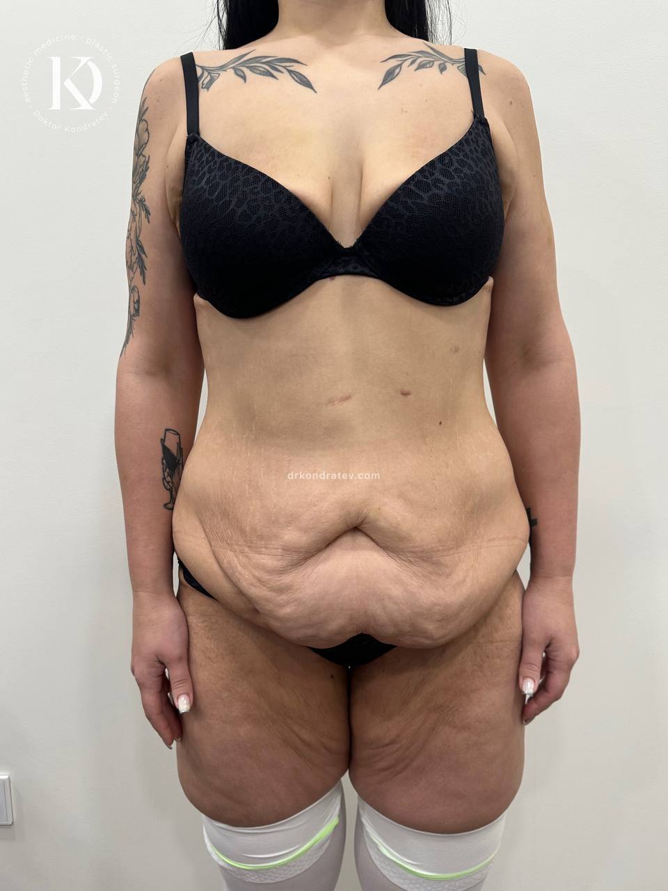Body Correction After Massive Weight Loss, Part 2 - My, Redheads, Video, Vertical video, Longpost, Booty