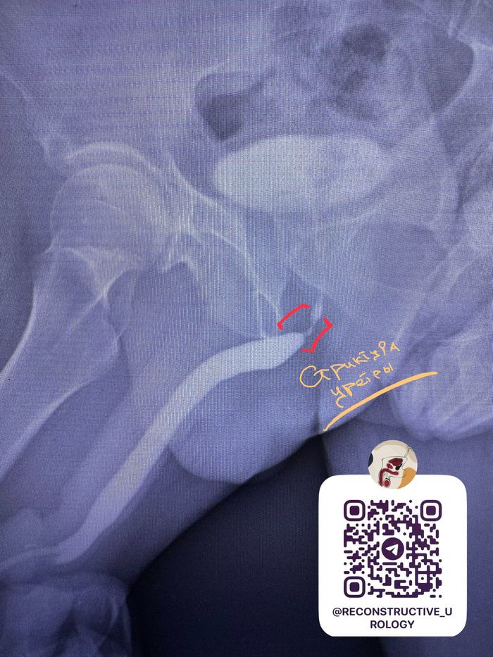 Стриктура бульбозного отдела уретры после катетеризация мочевого пузыря