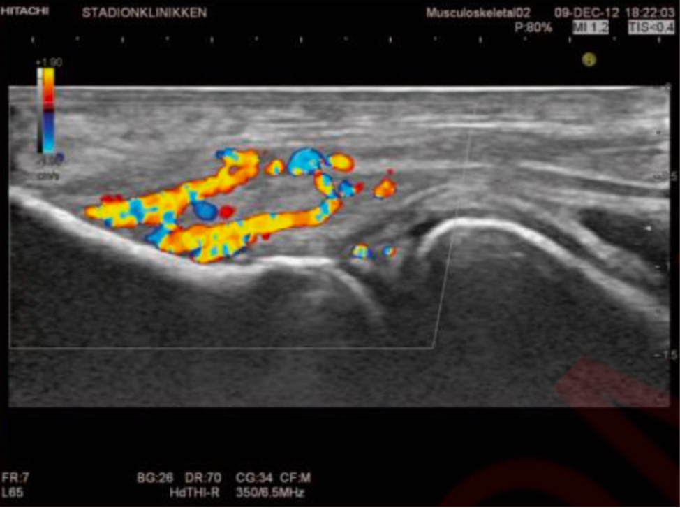Elbow Pain. Part II. Inflammatory Diseases - My, Health, The medicine, Rheumatology, Rheumatologist, Rheumatoid arthritis, Bechterew's disease, Ankylosing spondylitis, Psoriatic arthritis, Gout, Infection, Disease, Longpost