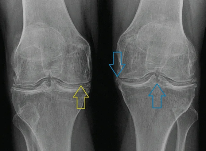 Elbow Pain. Part II. Inflammatory Diseases - My, Health, The medicine, Rheumatology, Rheumatologist, Rheumatoid arthritis, Bechterew's disease, Ankylosing spondylitis, Psoriatic arthritis, Gout, Infection, Disease, Longpost