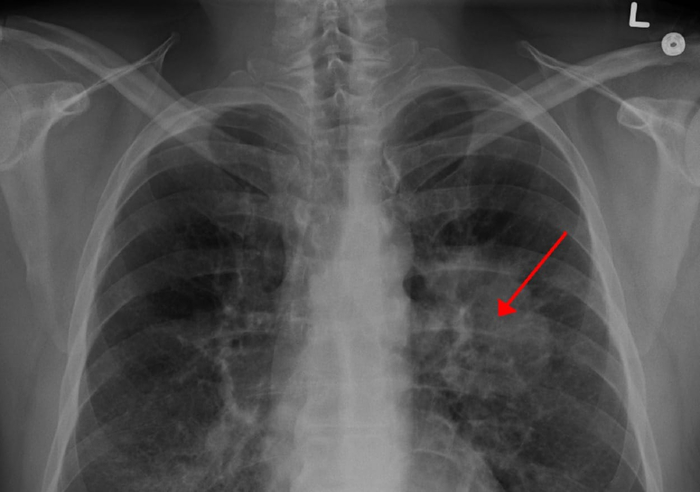 �������������� ������� ������, ��������������� ������� � ������ / � James Heilman, MD, Wikipedia