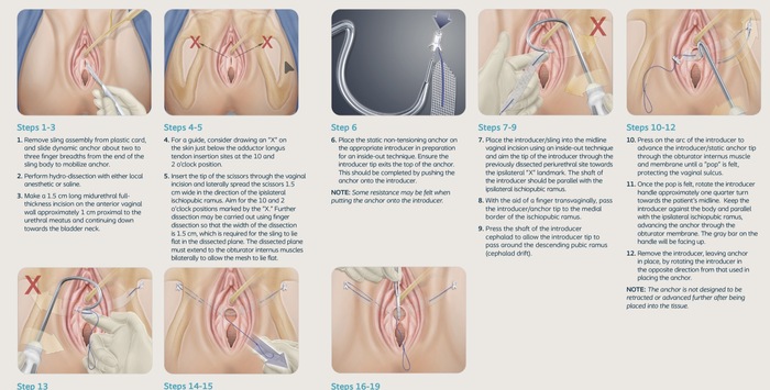 Altis® Single Incision Sling