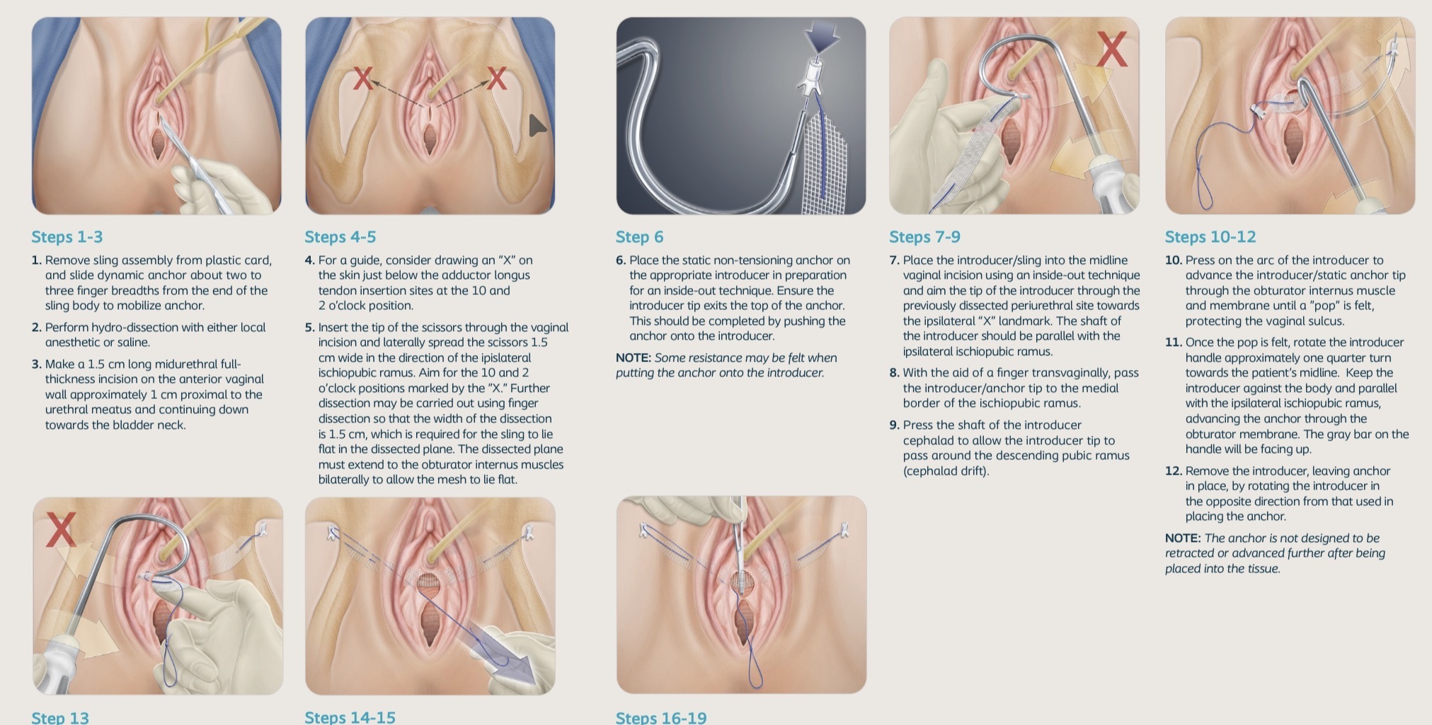 Minimally invasive treatments for stress urinary incontinence in women - My, Research, Surgery, The medicine, The science, Urology, Operation, Treatment, Help, Video, Longpost