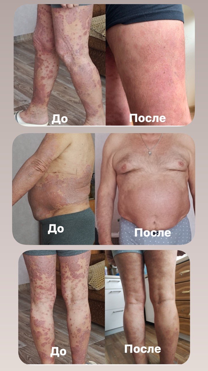 The amazing is near, but it is forbidden - My, Psoriasis, Treatment, Radiotherapy, Result, Immunity, Disease, Immunology, Longpost