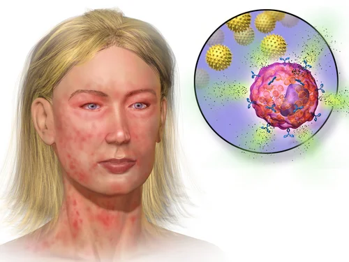 Where do allergies come from and what do worms have to do with it? - My, Nauchpop, Health, Worms, Allergy, Immunity, Free translation, Video, Youtube, Longpost