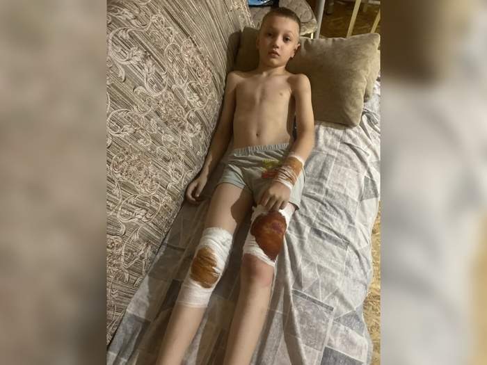 «Он кричал от боли на всю улицу». Под Тюменью бойцовская собака покусала ребенка – хозяева пса оставили мальчика лежать в грязи