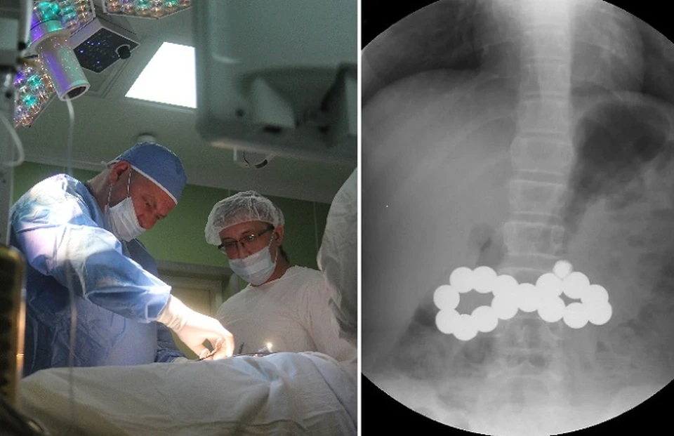 In Pyatigorsk, doctors saved a baby who swallowed 17 magnetic balls. - My, Negative, Surgeon, Children, Magnets