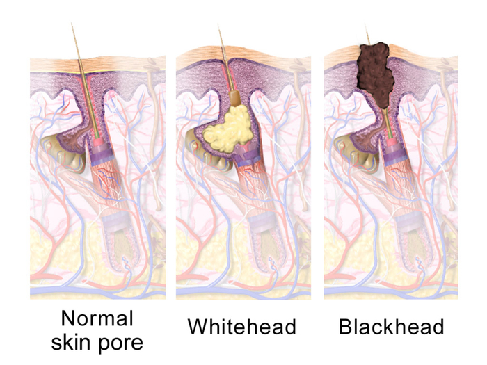 ��� ��� ��������� ������� (<a href="https://en.wikipedia.org/wiki/Comedo#/media/File:Blausen_0811_SkinPores.png" target="_blank" rel="nofollow noopener">��������: BruceBlaus</a>)