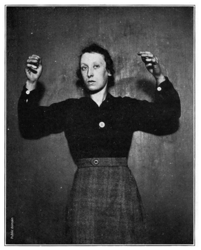 Пациентка с постэнцефалитическим синдромом, фотография из монографии А. Дж. Холла «Epidemic encephalitis» (1924). Холл отмечал «безэмоциональное лицо» и ослабленную волю. Пациентка не сопротивлялась, когда ей поднимали руки.